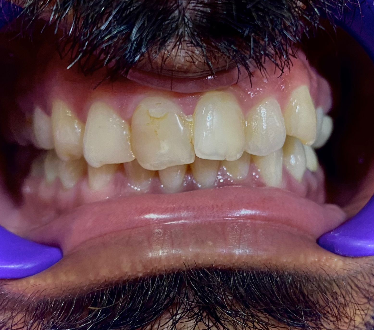 During Treatment